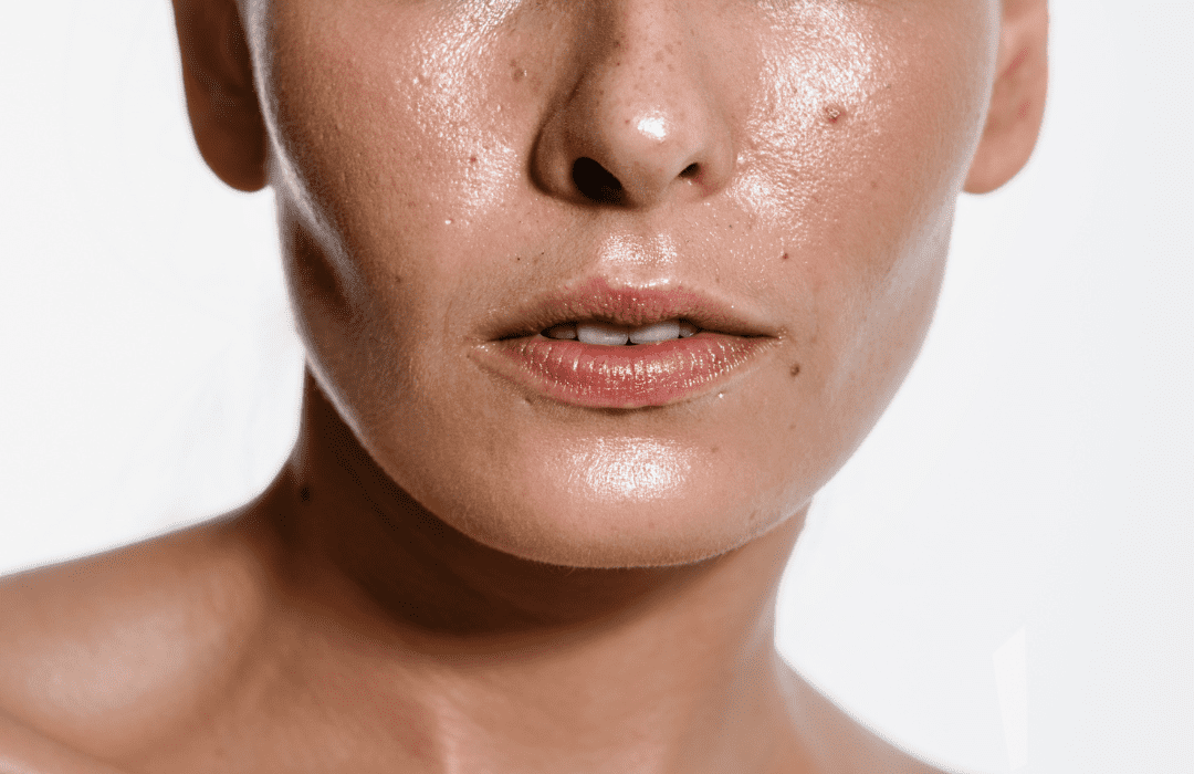 oily skin